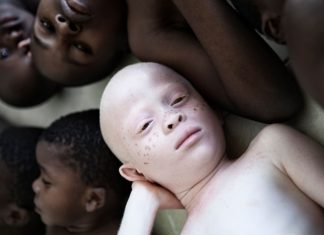 Mali : les albinos paient de leur vie les superstitions Mali : les albinos paient de leur vie les superstitions