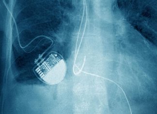 Scandale Implant Files : 80.000 morts chaque année Scandale Implant Files : 80.000 morts chaque année