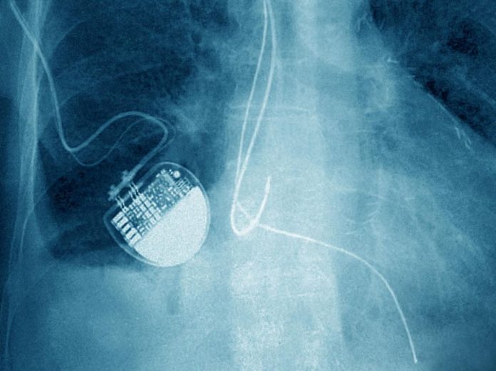 Scandale Implant Files : 80.000 morts chaque année