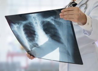 Agence médicaments : Implants contraceptifs retrouvés dans les poumons Agence médicaments : Implants contraceptifs retrouvés dans les poumons