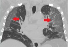 Coronavirus : Les caillots de sang causés par le Covid-19 (détail) Coronavirus : Les caillots de sang causés par le Covid-19 (détail)