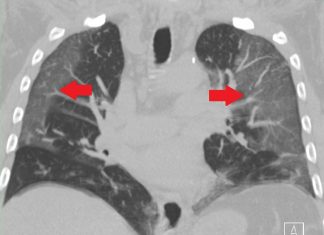 Coronavirus : Les caillots de sang causés par le Covid-19 (détail) Coronavirus : Les caillots de sang causés par le Covid-19 (détail)
