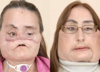 Connie Culp : La première Américaine greffée du visage est morte Connie Culp : La première Américaine greffée du visage est morte