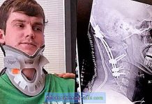 A 22 ans, il survit miraculeusement à une « décapitation interne » (VIDEO) A 22 ans, il survit miraculeusement à une "décapitation interne"