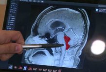 Video : Victime de violentes migraines, il découvre qu’un ver solitaire vit dans son cerveau depuis 10 ans Video : Victime de violentes migraines, il découvre qu'un ver solitaire vit dans son cerveau depuis 10 ans
