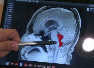 Video : Victime de violentes migraines, il découvre qu’un ver solitaire vit dans son cerveau depuis 10 ans Video : Victime de violentes migraines, il découvre qu'un ver solitaire vit dans son cerveau depuis 10 ans