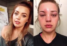 Elle pensait n’avoir qu’un simple bouton au-dessus de l’œil, elle n’aurait jamais dû le percer ! (détail) Elle pensait n'avoir qu'un simple bouton au-dessus de l'œil, elle n'aurait jamais dû le percer ! (détail)
