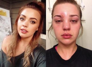 Elle pensait n’avoir qu’un simple bouton au-dessus de l’œil, elle n’aurait jamais dû le percer ! (détail) Elle pensait n'avoir qu'un simple bouton au-dessus de l'œil, elle n'aurait jamais dû le percer ! (détail)