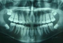 Il meurt 15 jours après son opération des dents de sagesse (détail) Il meurt 15 jours après son opération des dents de sagesse (détail)