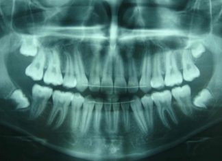 Il meurt 15 jours après son opération des dents de sagesse (détail) Il meurt 15 jours après son opération des dents de sagesse (détail)