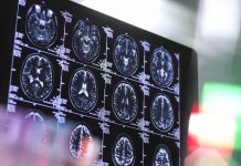 Étude : Le Covid-19 peut entraîner une réduction de la taille du cerveau Étude : Le Covid-19 peut entraîner une réduction de la taille du cerveau