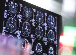Étude : Le Covid-19 peut entraîner une réduction de la taille du cerveau Étude : Le Covid-19 peut entraîner une réduction de la taille du cerveau