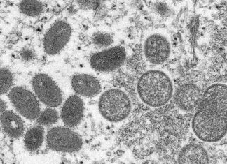 Un premier cas suspect de variole du singe détecté en France, ce que l'on sait