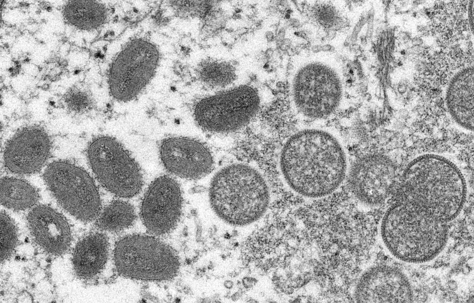 Un premier cas suspect de variole du singe détecté en France, ce que l'on sait