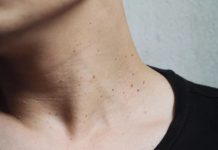 Faut-il Enlever les Acrochordons ? Voici Ce qu’il Faut Savoir Faut-il Enlever les Acrochordons ? Voici Ce qu'il Faut Savoir