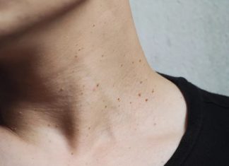 Faut-il Enlever les Acrochordons ? Voici Ce qu’il Faut Savoir Faut-il Enlever les Acrochordons ? Voici Ce qu'il Faut Savoir