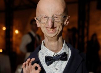 Hommage à Sammy Basso : Un exemple de courage face à la progéria Sammy Basso, le malade le plus âgé au monde atteint de vieillissement prématuré, est mort à 28 ans